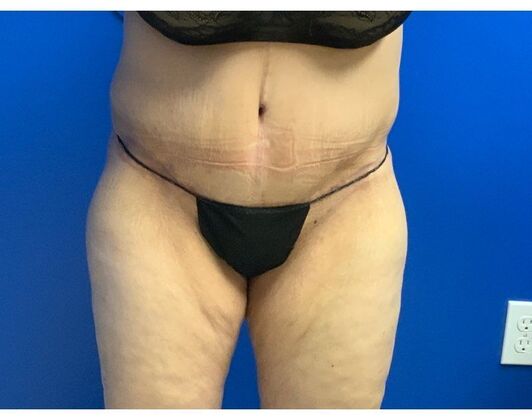 Abdominoplasty: Case 32 - After