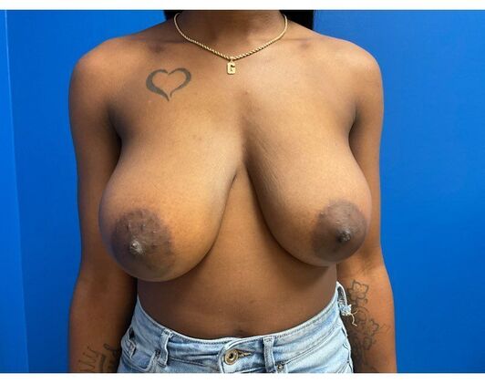 Breast Reduction Case 17 - Before