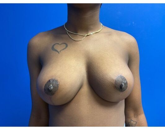 Breast Reduction Case 17 - After