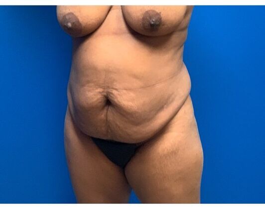 Abdominoplasty Case 33 - Before