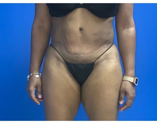 Abdominoplasty Case 33 - After