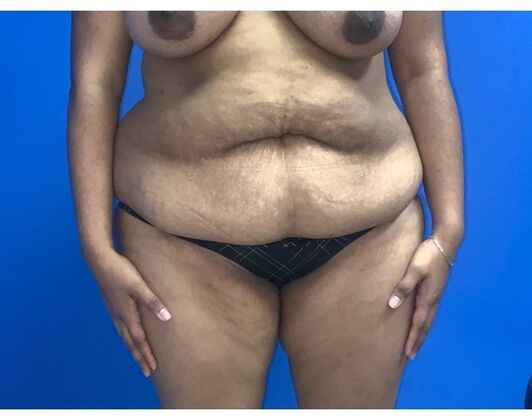 Abdominoplasty Case 34 - Before