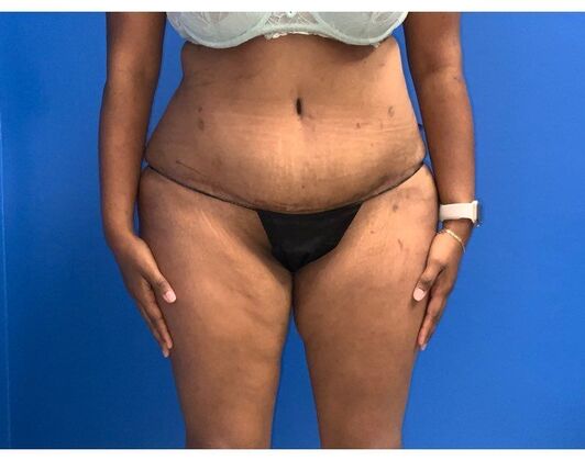 Abdominoplasty Case 34 - After