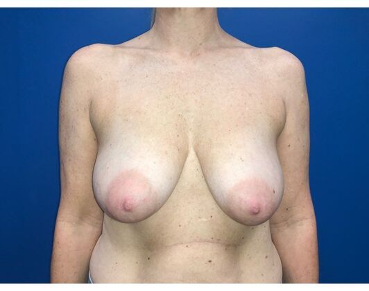 Mastopexy: Case 22 - Before