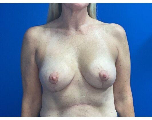 Mastopexy: Case 22 - After