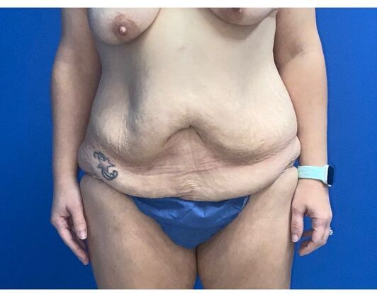 Abdominoplasty Case 35 - Before