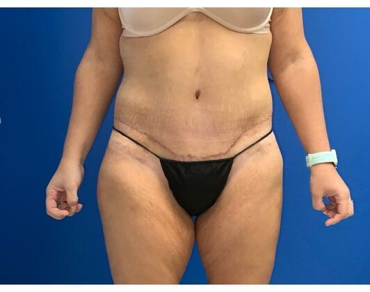 Abdominoplasty Case 35 - After