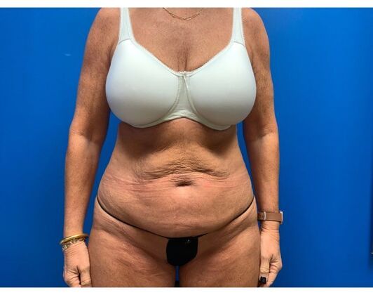 Abdominoplasty Case 36 - Before