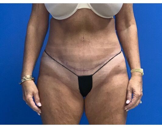 Abdominoplasty Case 36 - After