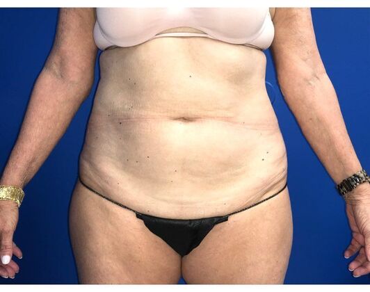 Abdominoplasty Case 37 - Before