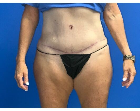 Abdominoplasty Case 37 - After