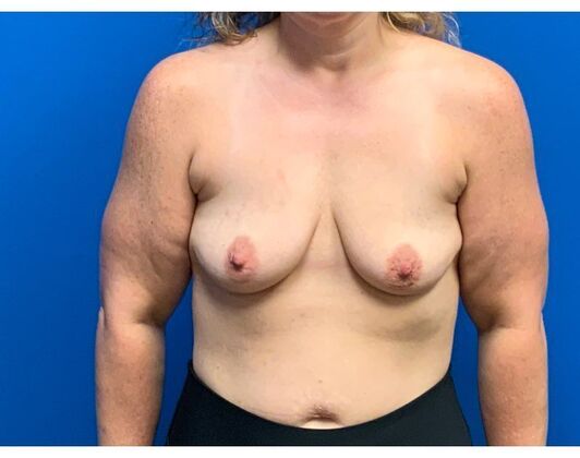 Breast Augmentation Case 38 - Before