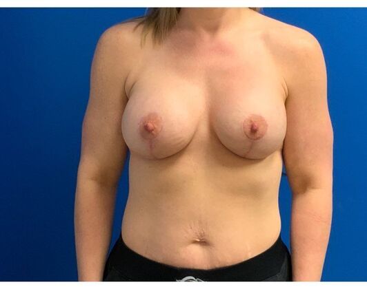 Breast Augmentation Case 38 - After
