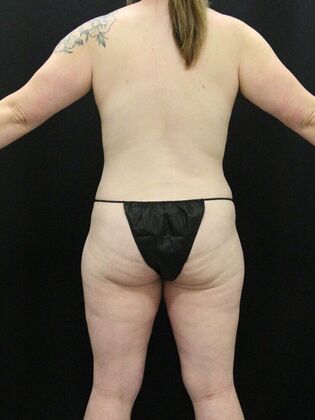 Tummy Tuck: Case 53 - After