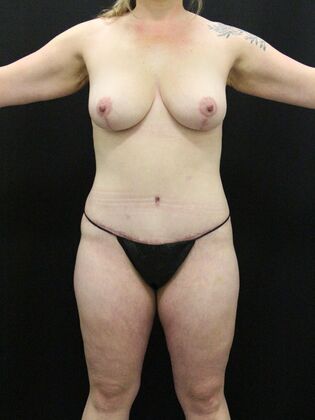 Tummy Tuck Case 53 - After
