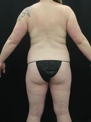 Tummy Tuck: Case 53 - Before