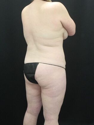 Tummy Tuck: Case 53 - Before