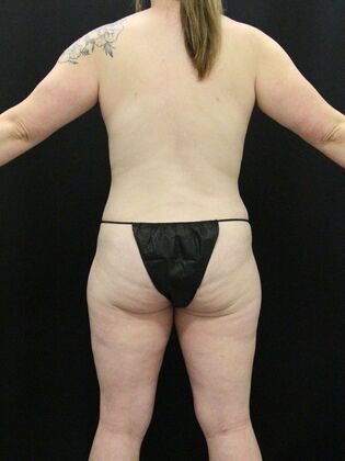 Liposuction Case 46 - After