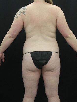 Liposuction Case 46 - Before