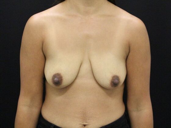 Breast Lift/Breast Lift Augmentation Case 57 - Before