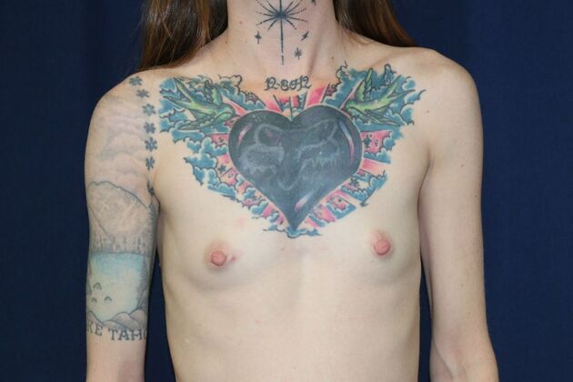 Breast Augmentation*: Case 78 - Before