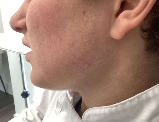 Scarring Case 1 - After