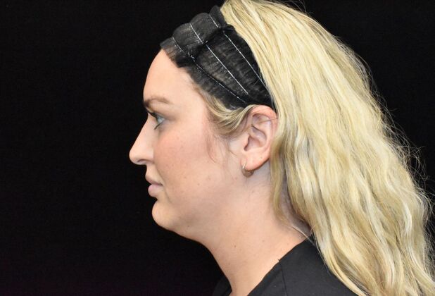 FaceTite: Case 3 - Before