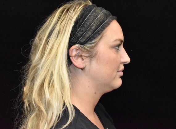 FaceTite: Case 3 - Before