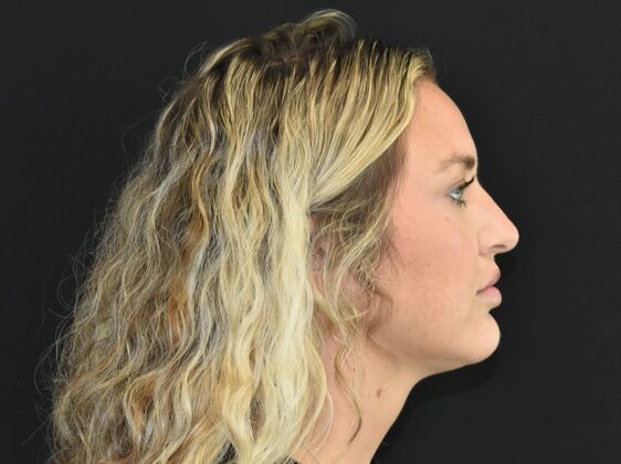 FaceTite: Case 3 - After