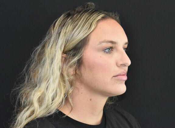 FaceTite: Case 3 - After