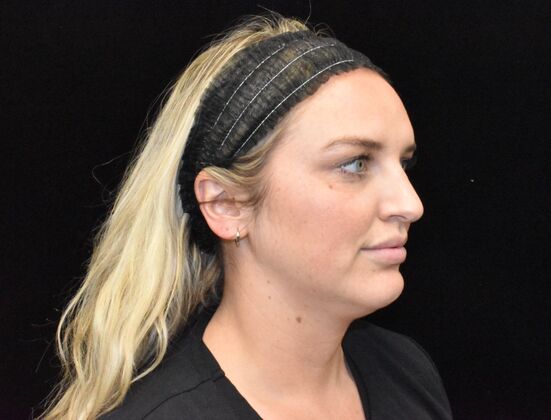 FaceTite: Case 3 - Before