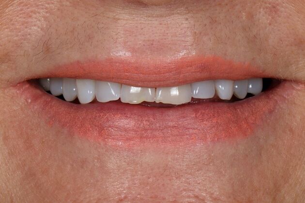 Porcelain Veneers: Victoria - Before
