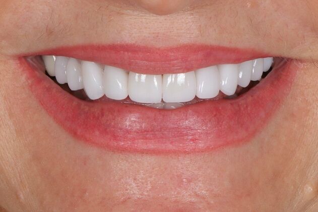 Porcelain Veneers: Victoria - After