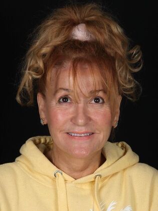 Porcelain Veneers Victoria - Before