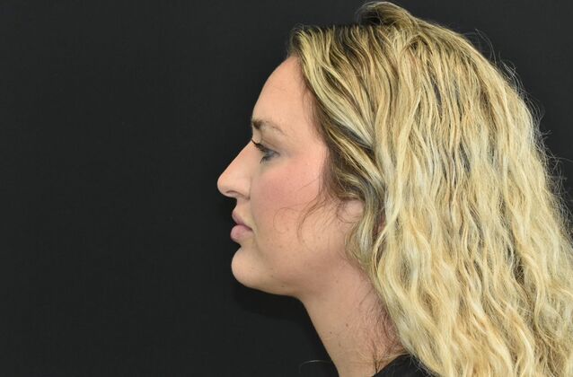 FaceTite: Case 3 - After