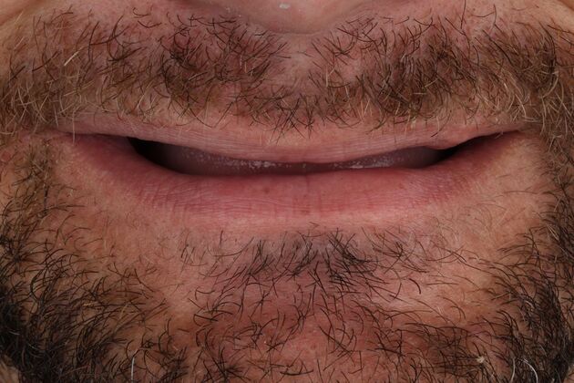 All-On-4/6: Walter- Fixed Total prosthesis - Before