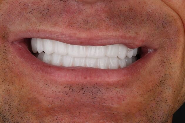 All-On-4/6: Walter- Fixed Total prosthesis - After