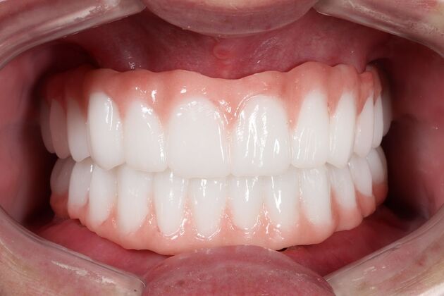 All-On-4/6: Walter- Fixed Total prosthesis - After