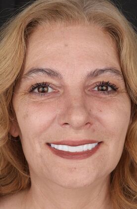 All-On-4/6: Jen_immediate fixed prosthesis - After