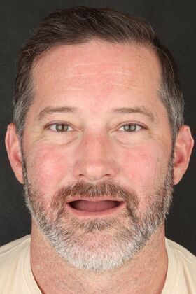 All-On-4/6: Liam V- Full Mouth implants - Before