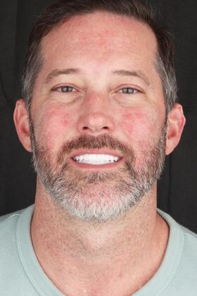 All-On-4/6: Liam V- Full Mouth implants - After