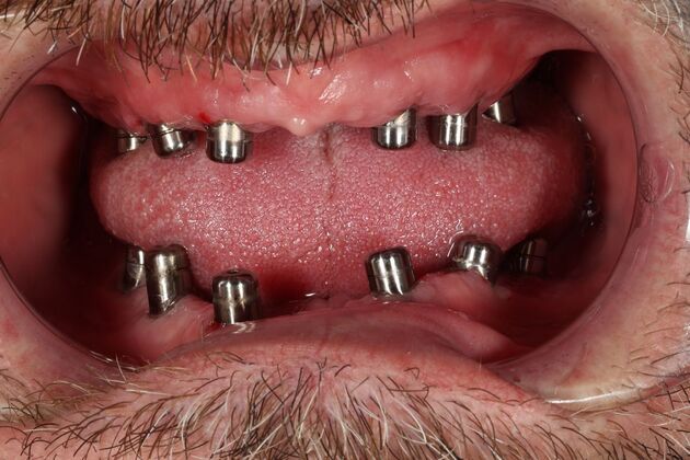 All-On-4/6: Liam V- Full Mouth implants - Before