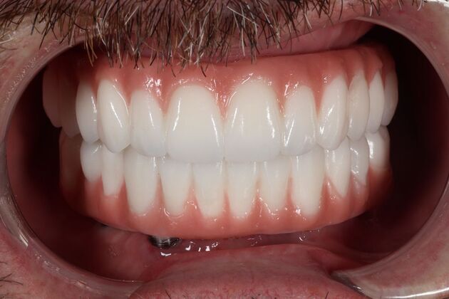 All-On-4/6: Liam V- Full Mouth implants - After