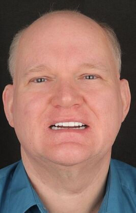 All-On-4/6: Tom- Fixed Denture - After