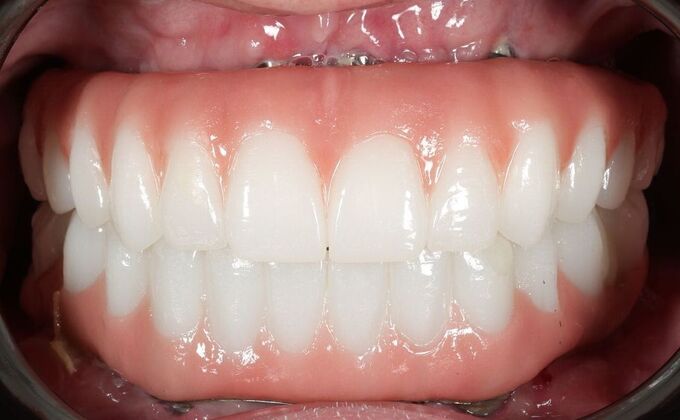 All-On-4/6: Tom- Fixed Denture - After