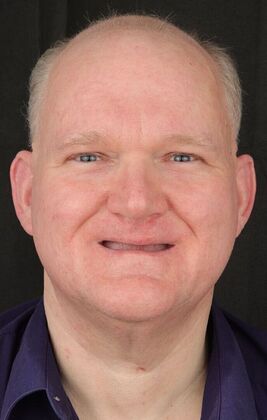 All-On-4/6: Tom- Fixed Denture - Before