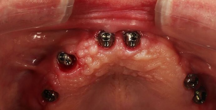 All-On-4/6: Tom- Fixed Denture - Before