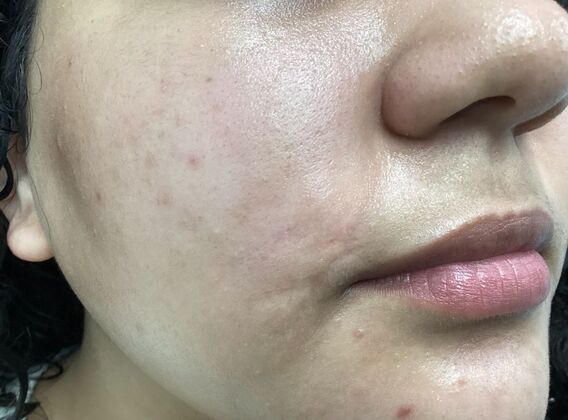 Scarring Case 2 - After