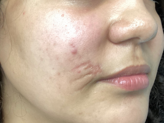 Scarring Case 2 - Before