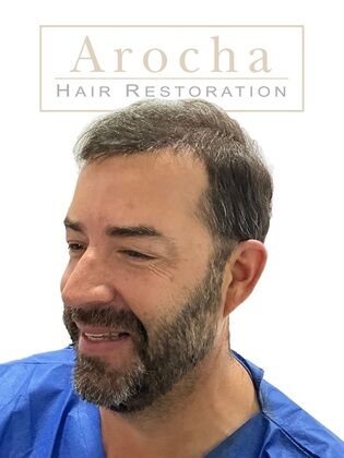 Long Hair FUE: Case 2 - Immediately post-op